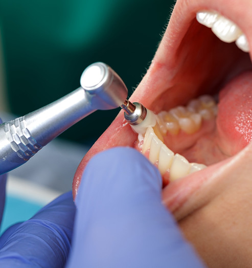 虫歯治療
